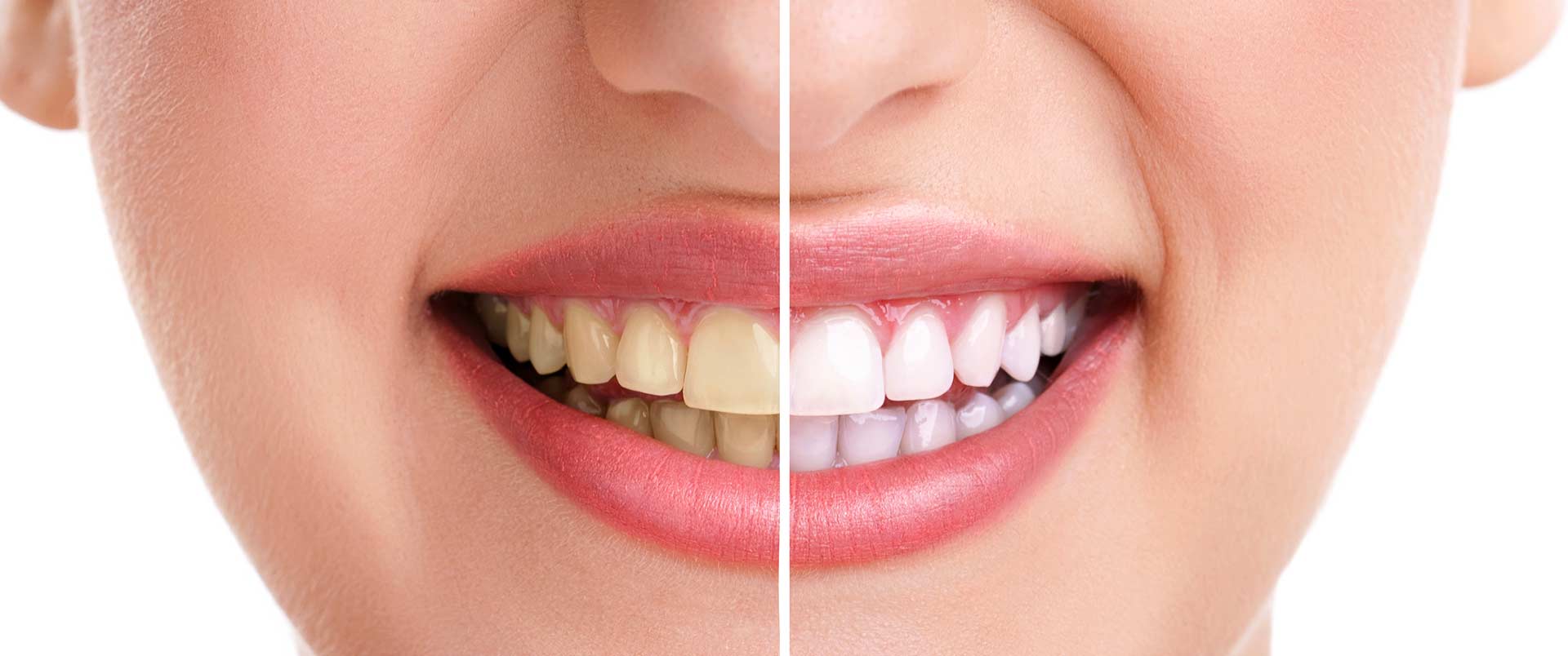 Cochrane Dental Centre | Teeth Whitening